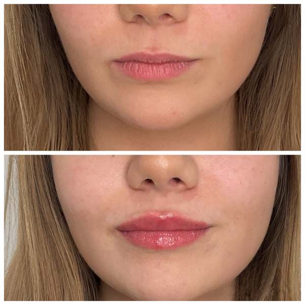 What to Expect Before and After Lip Filler Treatment at Hampton Health Wellness Aesthetics in Hopewell Junction, NY