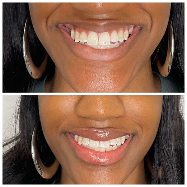 What to Expect Before and After Lip Filler Treatment at Hampton Health Wellness Aesthetics in Hopewell Junction, NY