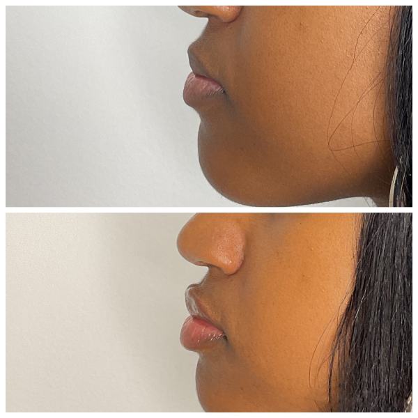 What to Expect Before and After Lip Filler Treatment at Hampton Health Wellness Aesthetics in Hopewell Junction, NY