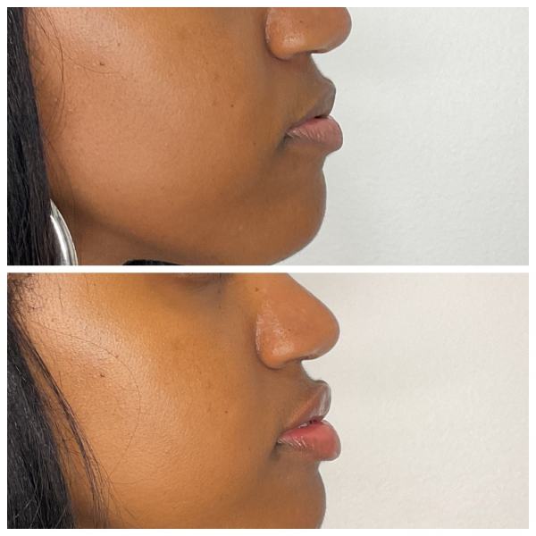 What to Expect Before and After Lip Filler Treatment at Hampton Health Wellness Aesthetics in Hopewell Junction, NY