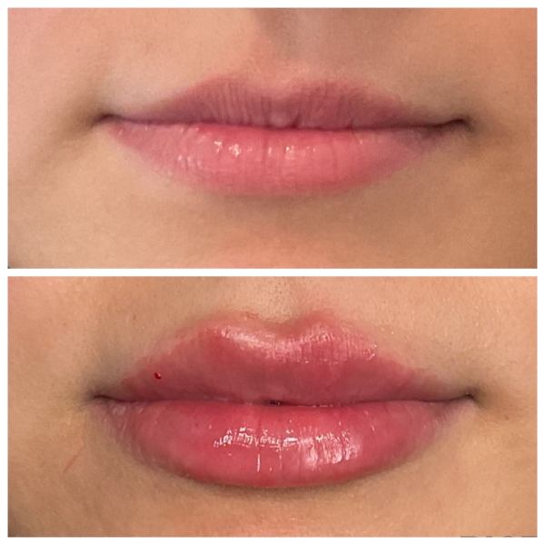 What to Expect Before and After Lip Filler Treatment at Hampton Health Wellness Aesthetics in Hopewell Junction, NY