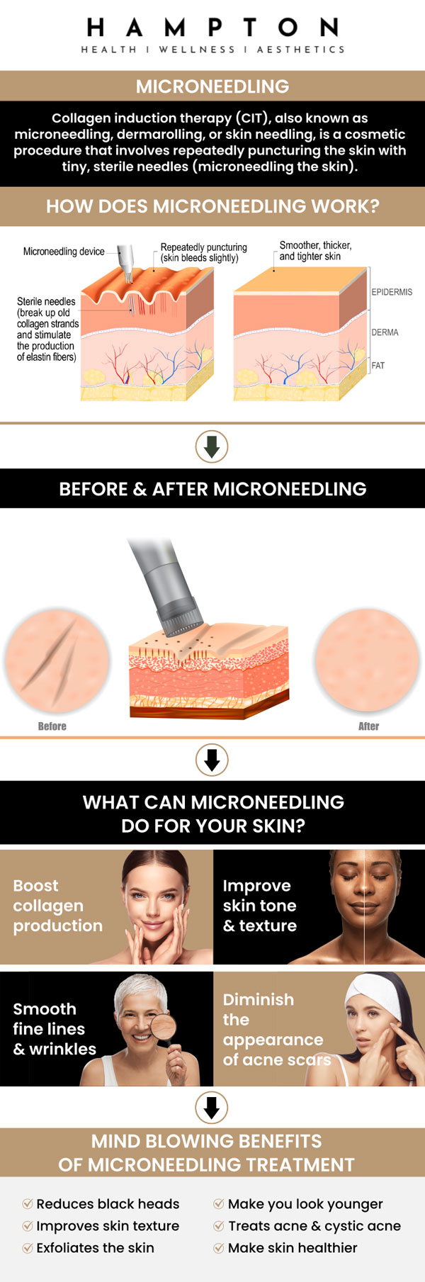 Microneedling is a minimally invasive cosmetic treatment that uses fine, sterile needles to create micro-punctures in the skin, triggering the body's natural wound-healing process. This targeted stimulation boosts collagen and elastin production, effectively reducing the appearance of acne scars. At Hampton Health Wellness & Aesthetics, Duane Hampton, NP, and Jeannie Ocasio-Hampton, NP, typically recommend a series of three to six sessions spaced roughly four to six weeks apart for optimal results, emphasizing strict sun protection and a gentle, hydrating aftercare routine to protect the skin barrier while it heals. For more information, contact us or book an appointment online. We are conveniently located at 2543 Route 52 Hopewell Junction, NY 12533.