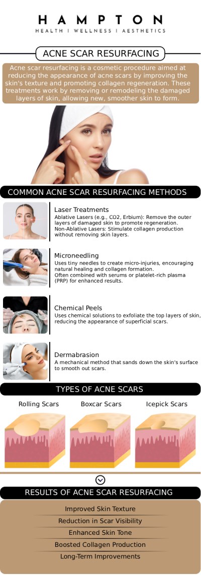 At Hampton Health Wellness Aesthetics in Hopewell Junction, Duane Hampton, NP, and Jeannie Ocasio-Hampton, NP provide advanced treatments to help you achieve clear, smooth skin by reducing stubborn acne scars. Duane and Jeannie will design a personalized skincare plan to diminish scarring and restore your confidence with a radiant, healthy complexion. We are conveniently located at 2543 Route 52 Hopewell Junction, NY 12533. For more information, contact us or book an appointment online.